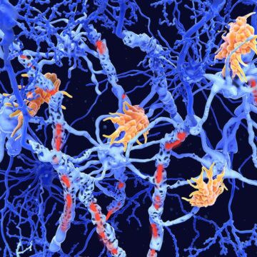 Multiple Sclerosis: Genetic marker for disease severity discovered

