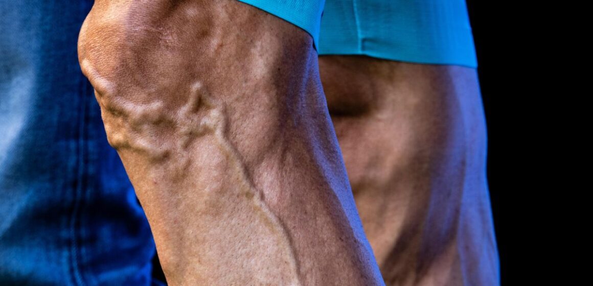 Ask the expert: Why do my legs have so many veins?

