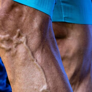 Ask the expert: Why do my legs have so many veins?

