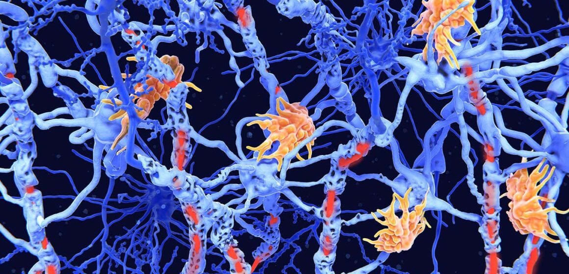 Multiple Sclerosis: Genetic marker for disease severity discovered

