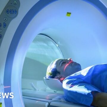 Long Covid: MRI scans reveal new clues to symptoms